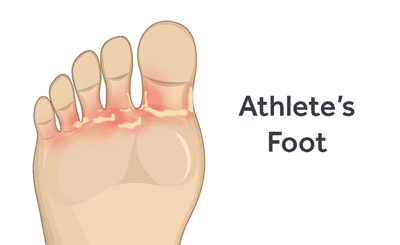 illustration of foot with athlete's foot